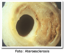 Imagen: Sección de una arteria con ateroesclerosis